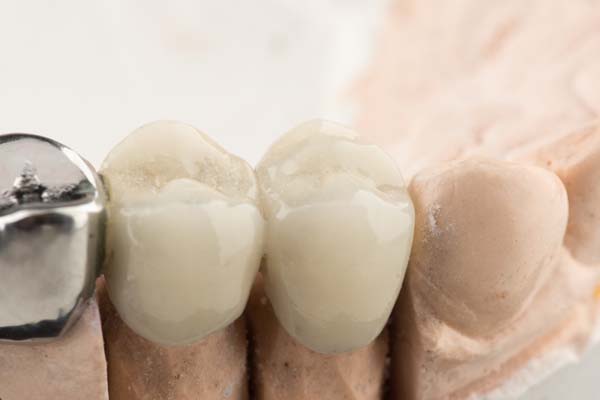 General Dentistry: What Is A Tooth Bridge?