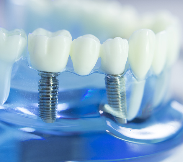 Bloomfield Dental Implants