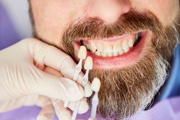 What Happens To The Teeth Under Dental Veneers?